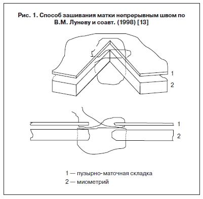 Способ зашивания матки непрерывным швом по В. М. Луневу и соавт. (1998) [13]