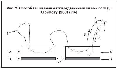 Способ зашивания матки отдельными швами по З. Д. Каримову (2001) [14]