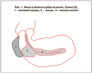 «Ниши» рубца на матке после кесарева сечения: диагностика, лечение и исходы
