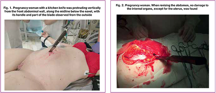 Obstetric bleeding due to penetrating stab-and-cut wounds to the uterus