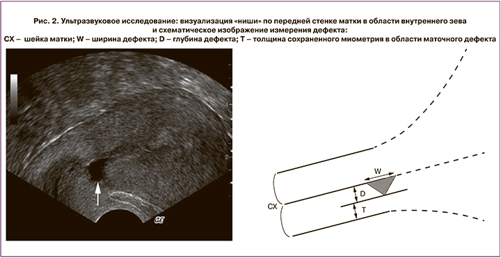 Лапаротомия метропластика (при несостоятельности рубца на матке после Кесарева сечения)