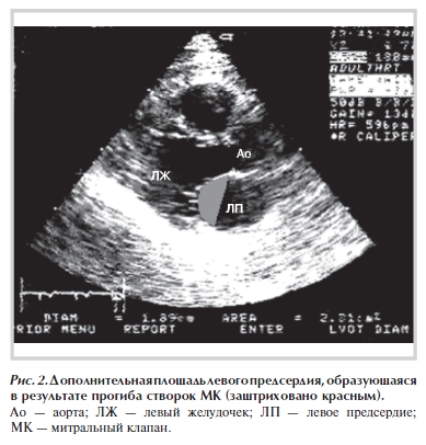 Дополнительная площадь левого предсердия, образующаяся в результате прогиба створок МК (заштриховано красным)