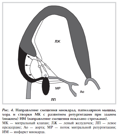 Направление смещения миокарда, папиллярной мышцы, хорд и створки МК с развитием регургитации при заднем (нижнем) ИМ (направление смещения показано стрелками)