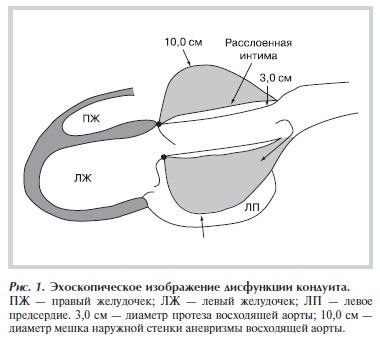 Эхоскопическое изображение дисфункции кондуита