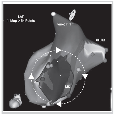 Трехмерная реконструкция ЛП на фоне атипичного ТП с циркуляцией импульса по периметру МК «по часовой стрелке»
