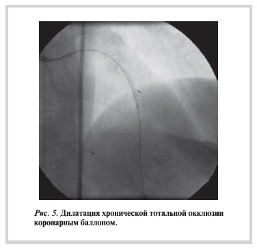 Дилатация хронической тотальной окклюзии коронарным баллоном