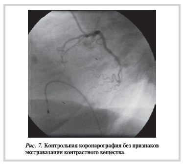 Контрольная коронарография без признаков экстравазации контрастного вещества