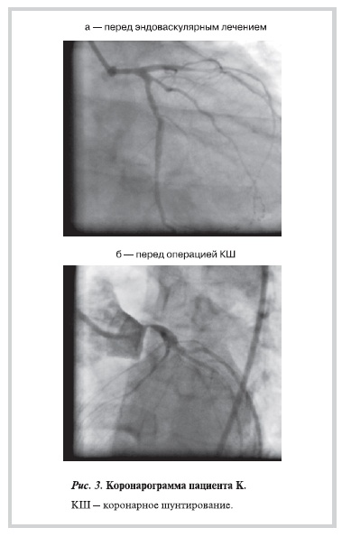 Коронарограмма пациента К.