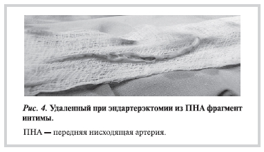 Удаленный при эндартерэктомии из ПНА фрагмент интимы