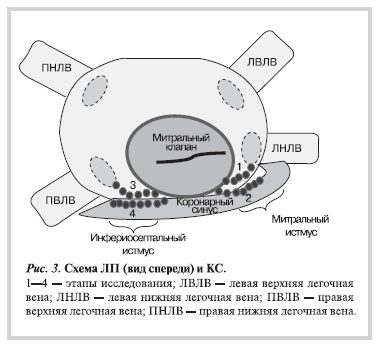 Схема ЛП (вид спереди) и КС