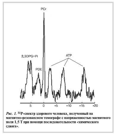 31Р-спектр здорового человека, полученный на магнитно-резонансном томографе с напряженностью магнитного поля 1,5 Т при помощи последовательности "химического сдвига"
