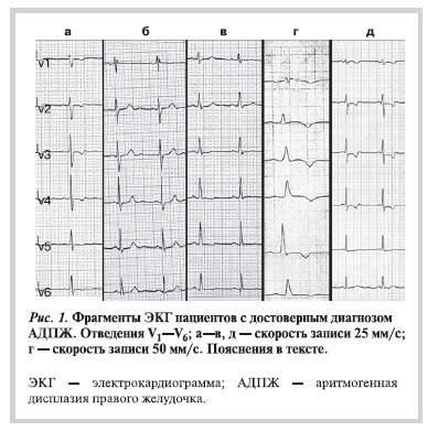 Фрагменты ЭКГ пациентов с достоверным диагнозом АДПЖ. Отведения V1-V6; а-в, д-скорость записи 25мм/c; г-скорость записи 50 мм/c. Пояснения в тексте.
