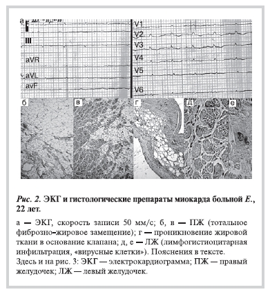 ЭКГ и гистологические препараты миокарда больной Е., 22 лет
