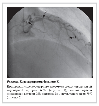 Коронарограма больного К.