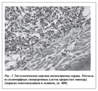 Гистологическая картина ангиосаркомы сердца. Опухоль из полиморфных гиперхромных клеток прорастает миокард (окраска гематоксилином и эозином, ув. 400)