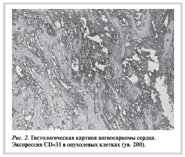 Гистологическая картина ангиосаркомы сердца. Экспрессия CD-31 в опухолевых клетках (ув. 200)
