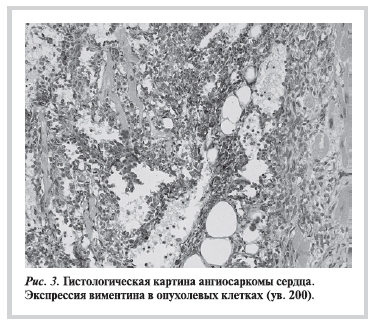 Гистологическая картина ангиосаркомы сердца. Экспрессия виментина в опухолевых клетках (ув. 200)