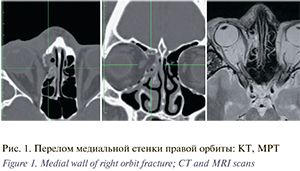 Перелом медиальной стенки орбиты