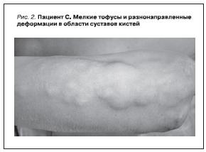 Пациент С. Мелкие тофусы и разнонаправленные деформации в области суставов кистей