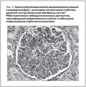 Криоглобулинемический мезангиокапиллярный гломерулонефрит: дольковая сегментация клубочка, двойной контур базальной мембраны за счет PAS-позитивных субэндотелиальных депозитов, полиферация мезангиальных клеток и небольшая инфильтрация клубочка моноцитами