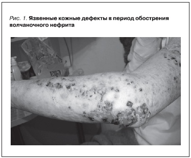 Язвенные кожные дефекты в период обострения волчаночного нефрита