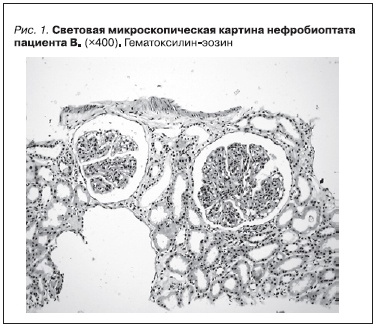 Световая микроскопическая картина нефробиоптата пациента В.