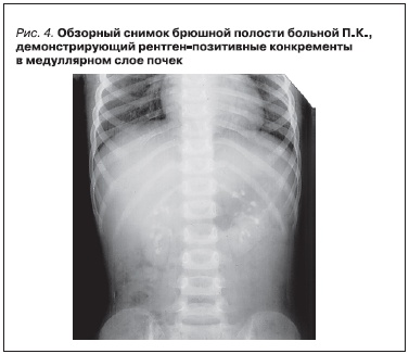 Обзорный снимок брюшной полости больной П. К., демонстрирующий рентген-позитивные конкременты в медуллярном слое почек