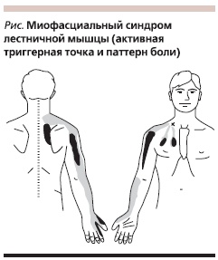 Миофасциальный синдром лестничной мышцы (активная триггерная точка и паттерн боли)