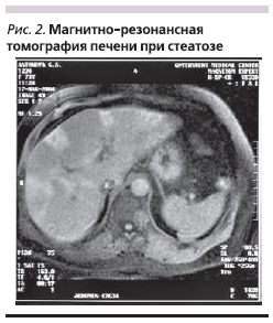 Магнитно-резонансная томография печени при стеатозе
