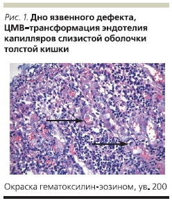 Дно язвенного дефекта цМВ-трансформация эндотелия капилляров слизистой обоочки толстой кишки