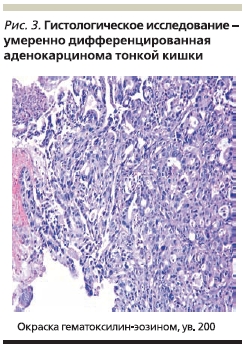 Гистологическое исследование - умеренно дифференцированная аденокарцинома тонкой кишки