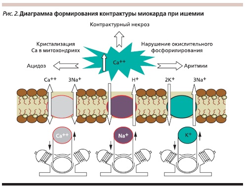 Диаграмма формирования контрактуры миокарда при ишемии