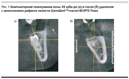 Компьютерная томограмма зоны 38 зуба до (а) и после (б) удаления с заполнением дефекта челюсти Gamalant-паста-ФОРТЕ Плюс