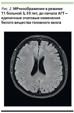 Микроангиопатия головного мозга fazekas. Лейкоареоз Фазекас. Лейкоареоз Fazekas 1. Лейкоареоз степени по Fazekas. Fazekas мрт.