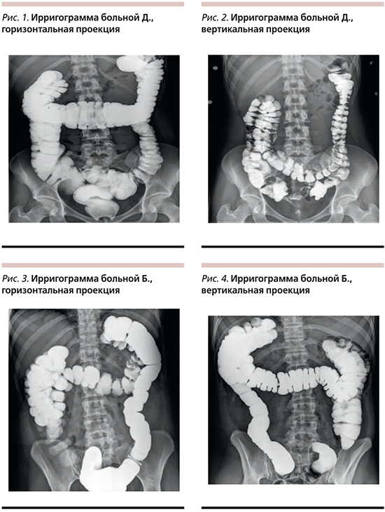 Долихосигма кишечника что это. Ирригоскопия кишечника 1 проекция что это такое. Дистопия кишки ирригоскопия кишечника. Синдром раздраженного кишечника рентген. Синдром Пайра ирригография.