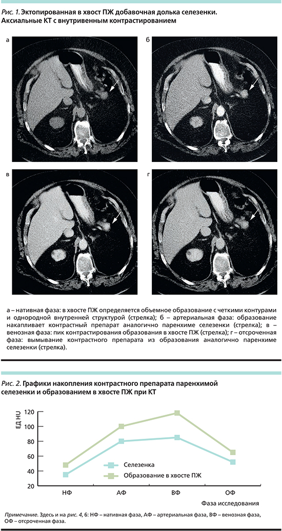 Долька селезенки. Дополнительная долька селезенки на УЗИ. Венозная фаза контрастирования при кт. Добавочная долька селезенки на кт.
