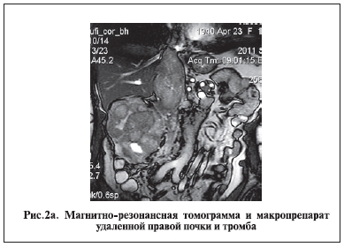 Магнитно-резонансная томогррамма и макропрепарат удаленной правой почки и тромба