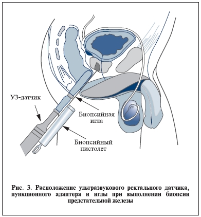 Расположение ультразвукового ректального датчика, пункционого адаптера и иглы при выполнении биопсии предстательной железы