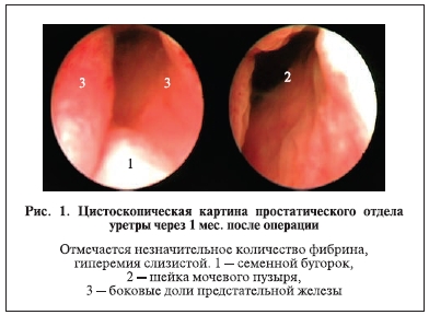 Цистоскопическая картина простатического отдела уретры через 1 мес. после операции