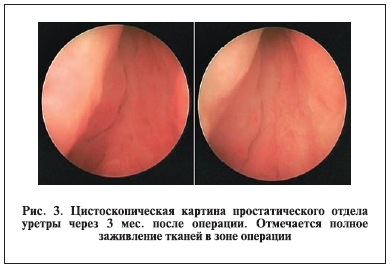 Цистоскопическая картина простатического отдела уретры через 3 мес. после операции. Отмечается полное заживление тканей в зоне операции