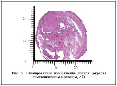 Сканированное изображение полипа (окраска гематоксилином и эозином)