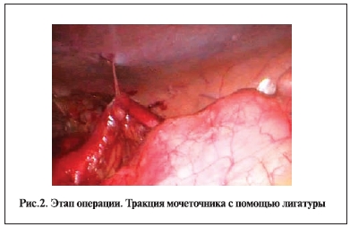 Этап операции. Тракция мочеточника с помощью лигатуры
