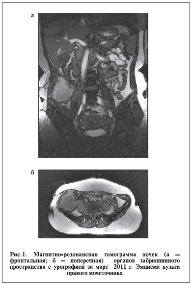 Магнитно-резонансная томограмма почек органов забрюшинного пространства с урографией за март 2011 г. Эмпиема культи правого мочеточника