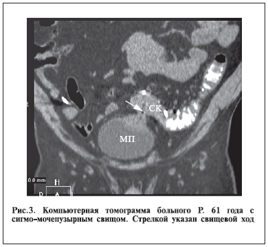 Компьютерная томограмма больного Р. 61 года с сигмо-мочепузырным свищом