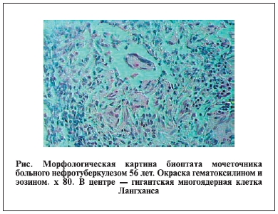 Морфологическая картина биоптата мочеточника больного нефротуберкулезом 56 лет