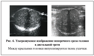 Ультразвуковое изображение поперечного среза головки полового члена в дистальной трети